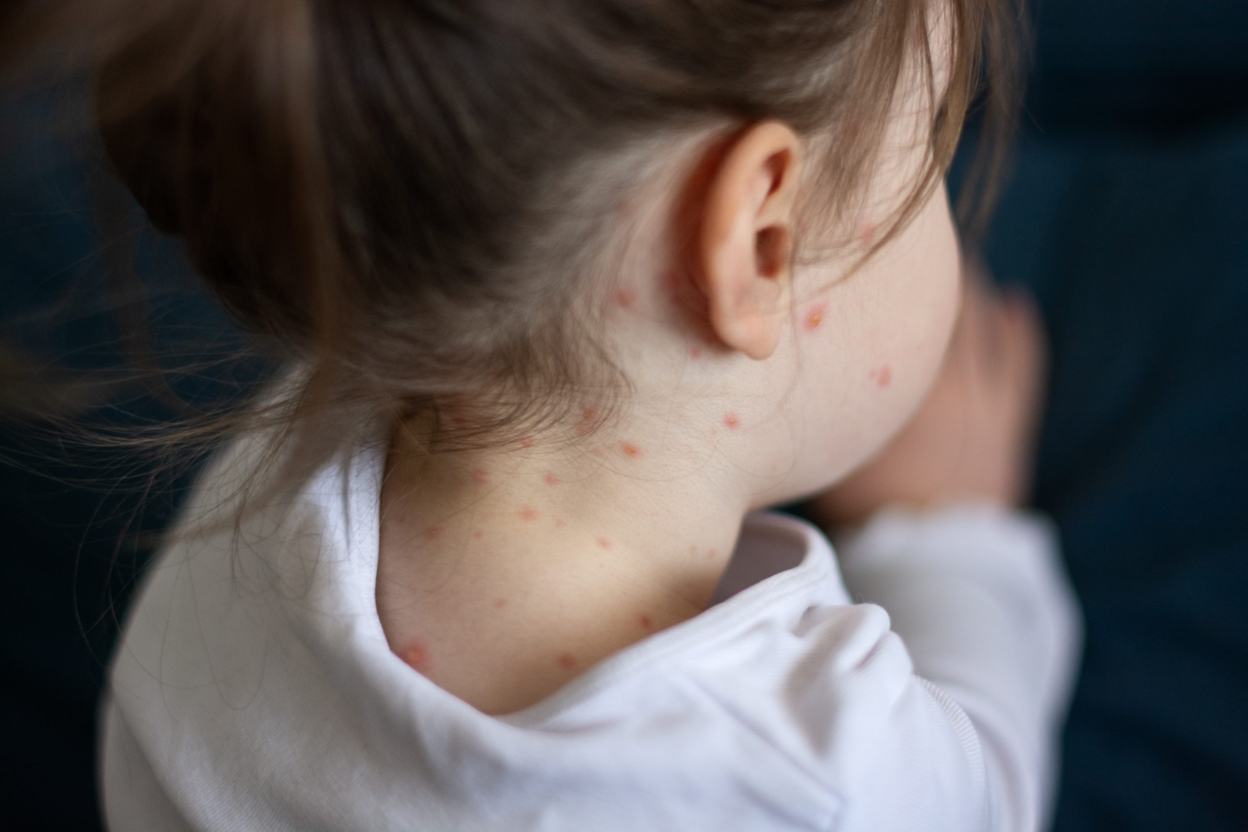 What to know about measles outbreak in the U.S.